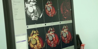 医学。心脏断层。