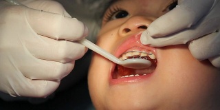牙医小心翼翼地反复调整亚洲宝宝的牙套。