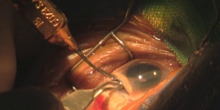 step 6. Surgery Cataract Eye. Category-A(clip 2)
