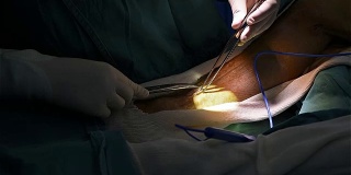 外科医生采集静脉用于冠状动脉旁路移植术