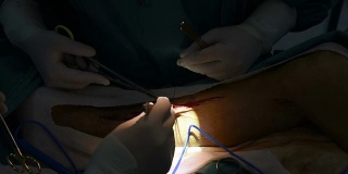 外科医生采集静脉用于冠状动脉旁路移植术