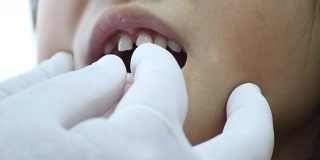 牙医检查小女孩的牙齿用手套摆动松动的牙齿