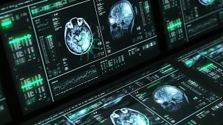 核磁共振脑部扫描电脑视频素材模板下载