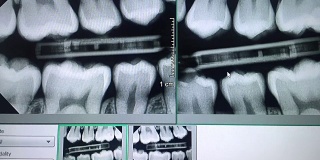 监视器上的牙齿全景x光