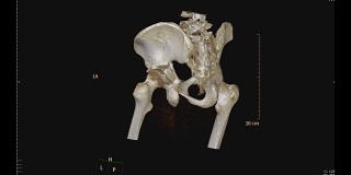 骨盆骨CT扫描。
