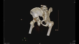 骨盆骨CT扫描。视频素材模板下载