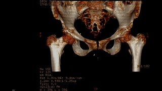 骨盆骨或双髋部CT扫描图像。视频素材模板下载