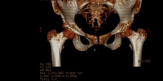 骨盆骨或双髋部CT扫描图像。
