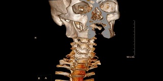 颈椎CT扫描。
