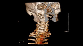 颈椎CT扫描。视频素材模板下载