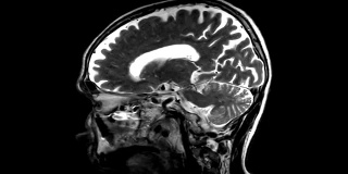 脑矢状面造影剂MRI