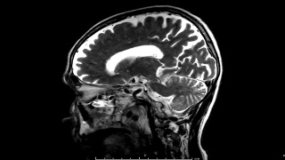 脑矢状面造影剂MRI视频素材模板下载
