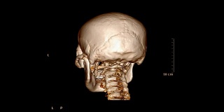 外伤患者颅骨/面骨的CT扫描
