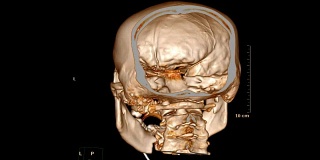气管内导管损伤颅骨/面骨的CT扫描。