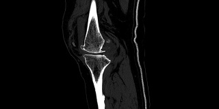 右膝CT扫描。