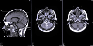MRI对脑矢状面和冠状面比较。