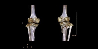 CT扫描双膝三维渲染图像在屏幕上旋转。