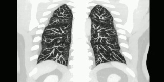 人体胸部/肺部CT扫描。