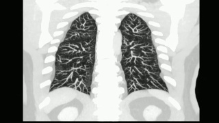 人体胸部/肺部CT扫描。视频素材模板下载