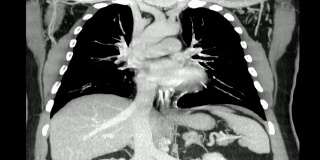 人体胸部CT扫描。