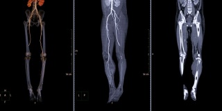 股动脉CTA流出，3D渲染图像