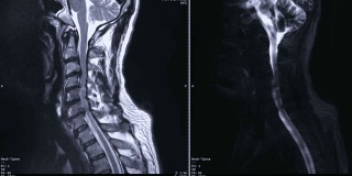 颈椎与脊髓矢状面MRI。