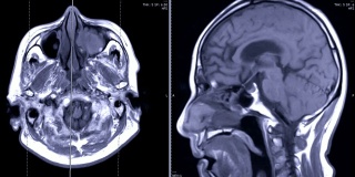 磁共振成像(MRI)的大脑轴向和矢状面造影剂