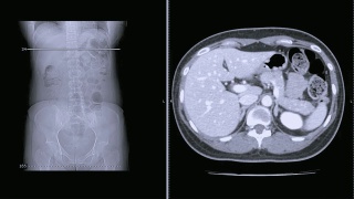 CT扫描/ CT全腹轴位造影剂扫描。阑尾炎的概念。视频素材模板下载
