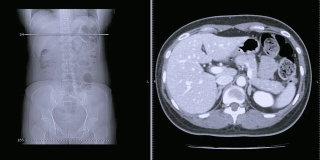 CT扫描/ CT全腹轴位造影剂扫描。阑尾炎的概念。