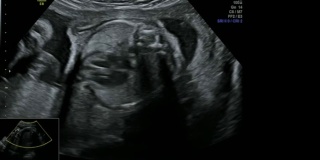 精彩的心脏跳动机制近距离-超声扫描妊娠3d和4d超声检查妊娠胎儿人类胚胎检查胎儿超声26周女婴妊娠中期