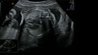 精彩的心脏跳动机制近距离-超声扫描妊娠3d和4d超声检查妊娠胎儿人类胚胎检查胎儿超声26周女婴妊娠中期视频素材模板下载
