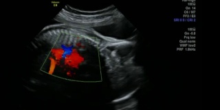 令人难以置信的颜色调整心率跳动插图-超声扫描妊娠3d和4d超声检查妊娠胎儿人类胚胎检查胎儿超声检查26周中期妊娠女婴