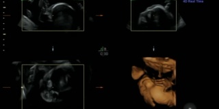 超声扫描妊娠3d & 4d超声检查妊娠胎儿人类胚胎检查胎儿超声检查26周妊娠中期