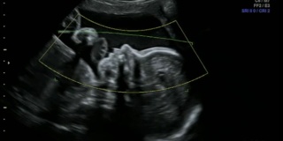 胎儿在母体子宫内摩擦鼻子和玩脐带-超声扫描妊娠3d和4d超声检查妊娠胎儿人类胚胎检查胎儿超声检查26周妊娠中期
