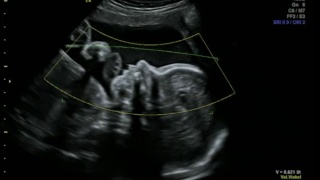 胎儿在母体子宫内摩擦鼻子和玩脐带-超声扫描妊娠3d和4d超声检查妊娠胎儿人类胚胎检查胎儿超声检查26周妊娠中期视频素材模板下载