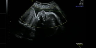 婴儿在母亲的子宫里安静地睡觉-超声扫描妊娠3d和4d超声检查妊娠胎儿检查人类胚胎胎儿超声检查26周妊娠中期