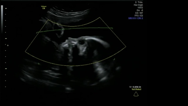 婴儿在母亲的子宫里享受平静的生活-超声扫描妊娠3d和4d超声检查妊娠胎儿人类胚胎检查胎儿超声检查26周妊娠中期