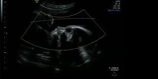 婴儿在母亲的子宫里享受平静的生活-超声扫描妊娠3d和4d超声检查妊娠胎儿人类胚胎检查胎儿超声检查26周妊娠中期