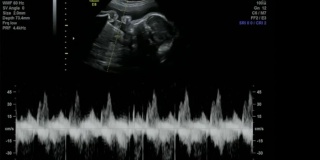 不可思议的婴儿心率声-超声扫描妊娠3d和4d超声检查妊娠胎儿人类胚胎检查胎儿超声检查26周中期妊娠女婴