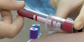 血液分析。鉴定HIV病毒的分析。