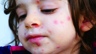 水痘疹近红点皮肤状况对儿童面部细节脓视频素材模板下载