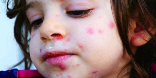 水痘疹近红点皮肤状况对儿童面部细节脓