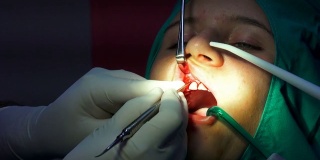 口腔牙科手术切缝、齿龈根尖切除囊肿清除