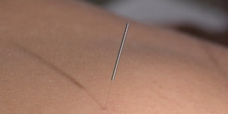 针灸针刺在女病人的背部