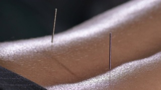 针灸针在一个女人的背部针灸视频素材模板下载