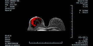 MRI扫描监测乳腺癌检测