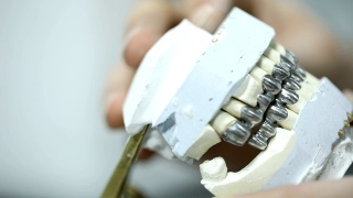 石膏颌上的牙桥视频素材模板下载