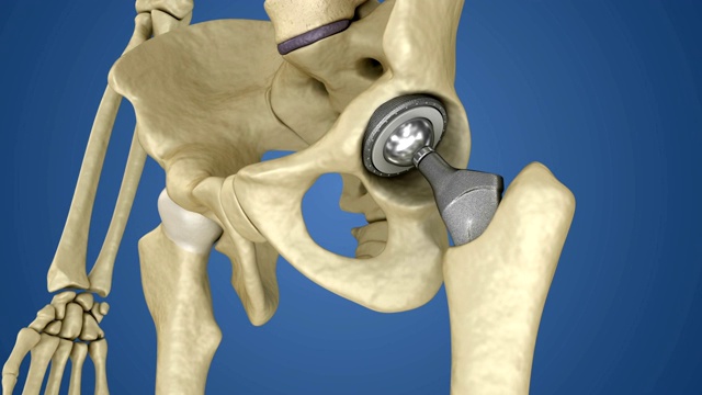 髋关节置换植入物安装在骨盆骨。医学精准3D动画