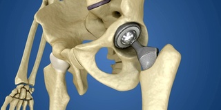 髋关节置换植入物安装在骨盆骨。医学精准3D动画