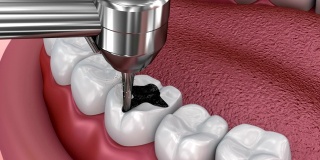 龋齿去除，牙裂填补，医学上准确的3D插图